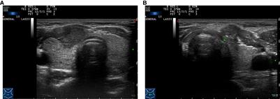 Nomogram model based on preoperative clinical characteristics of unilateral papillary thyroid carcinoma to predict contralateral medium-volume central lymph node metastasis